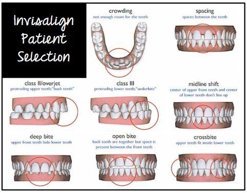 All About Invisalign